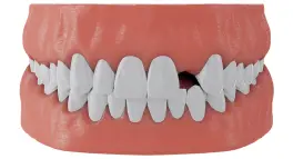 Missing Teeth