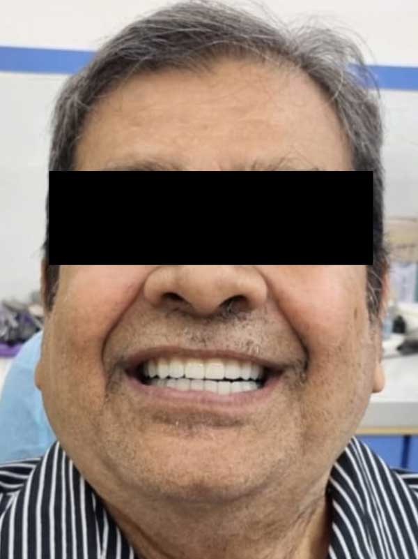 Implant After