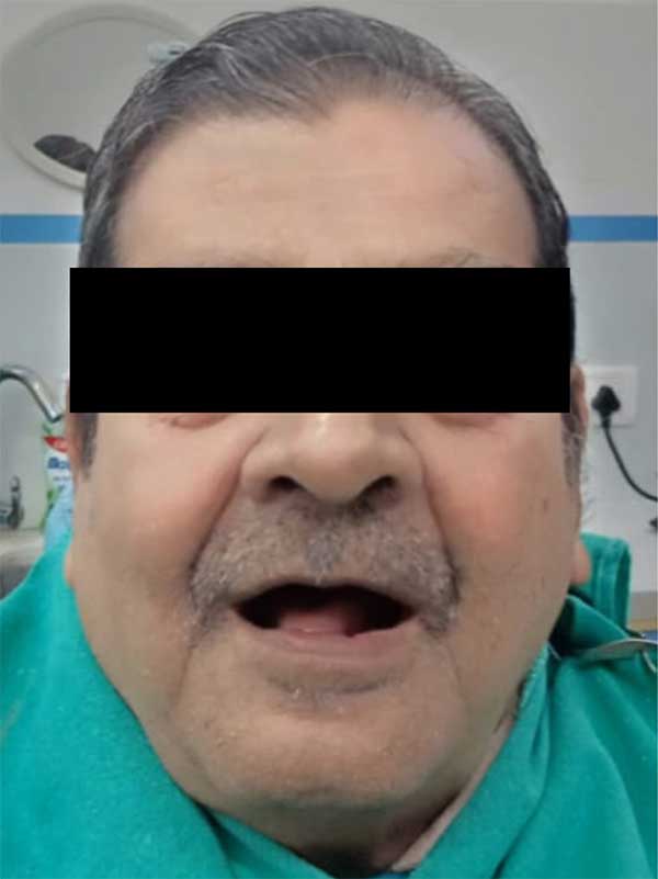 Implant Before