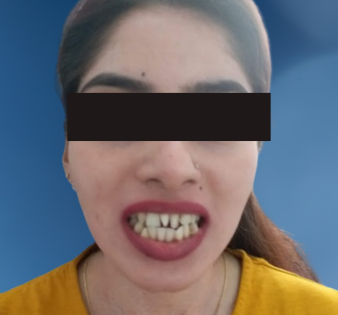 Smile Design After